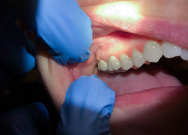 Best Broken or Chipped Tooth Repair in Chinook, MT